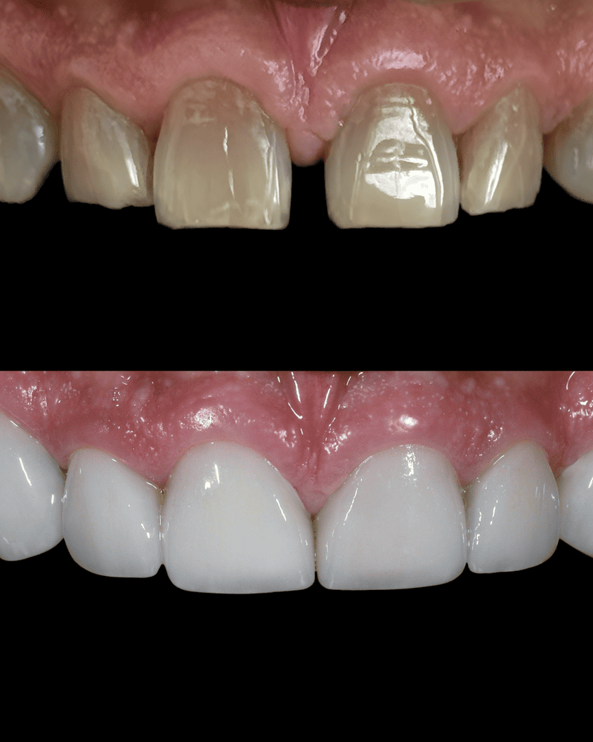 antes y después de un tratamiento de estética dental