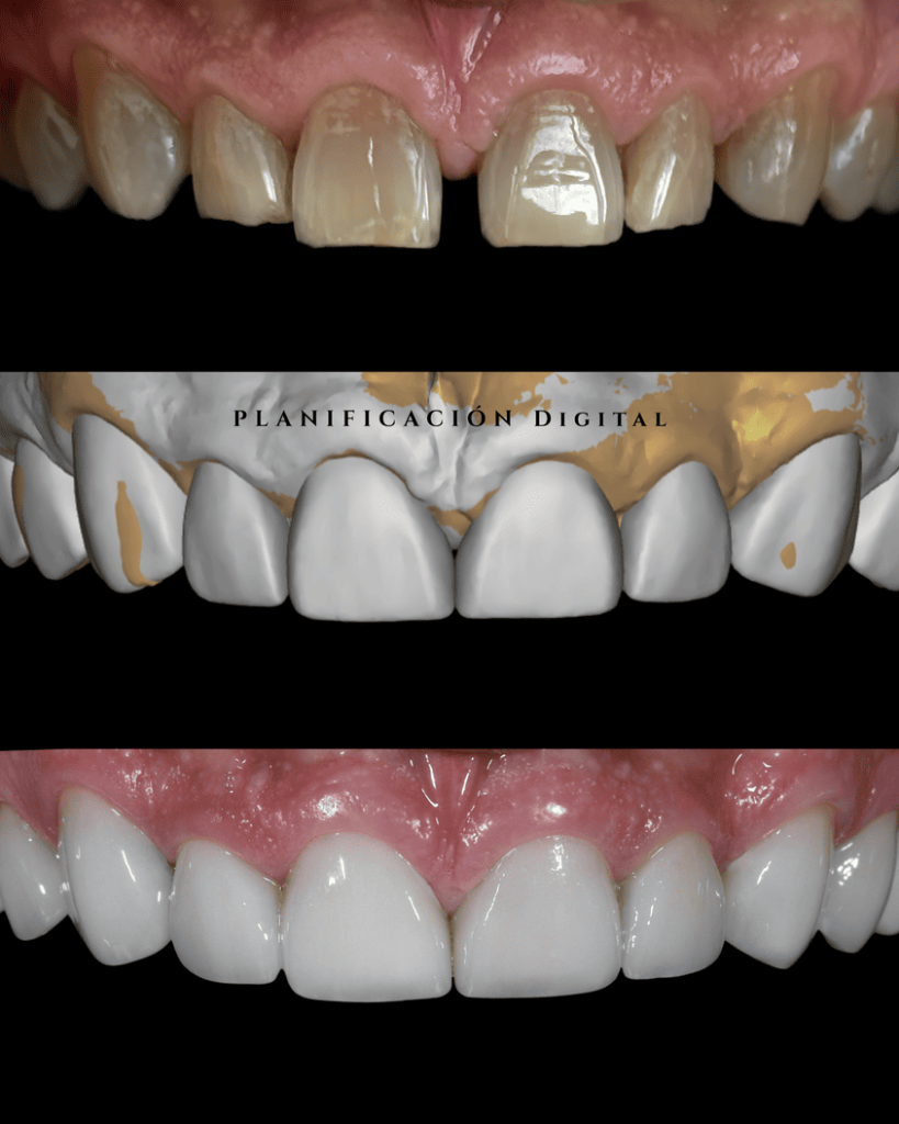 carillas de porcelana proceso del tratamiento