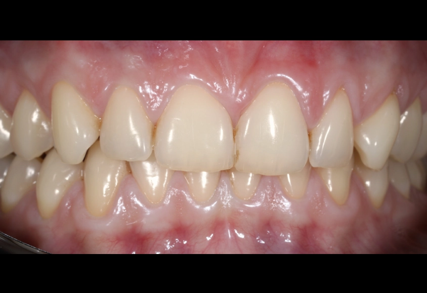 antes blanquemiento 3