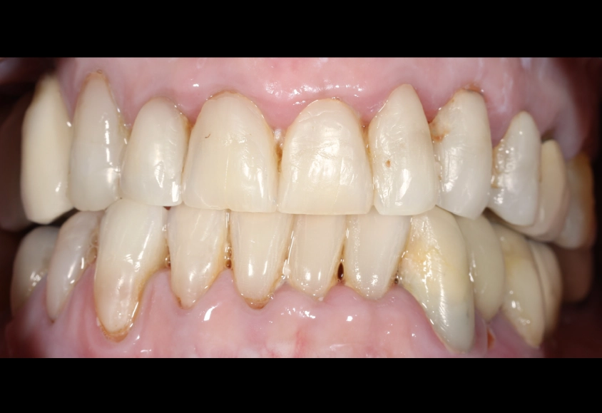 antes blanquemiento 4