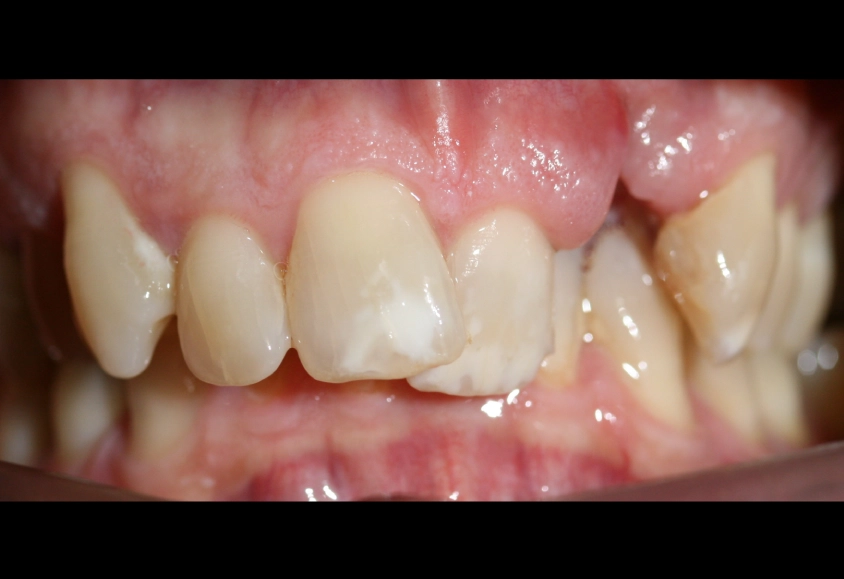 antes del tratamiento con brackets 1