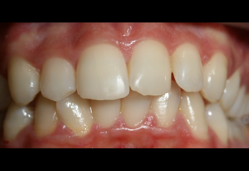 antes del tratamiento con brackets 2