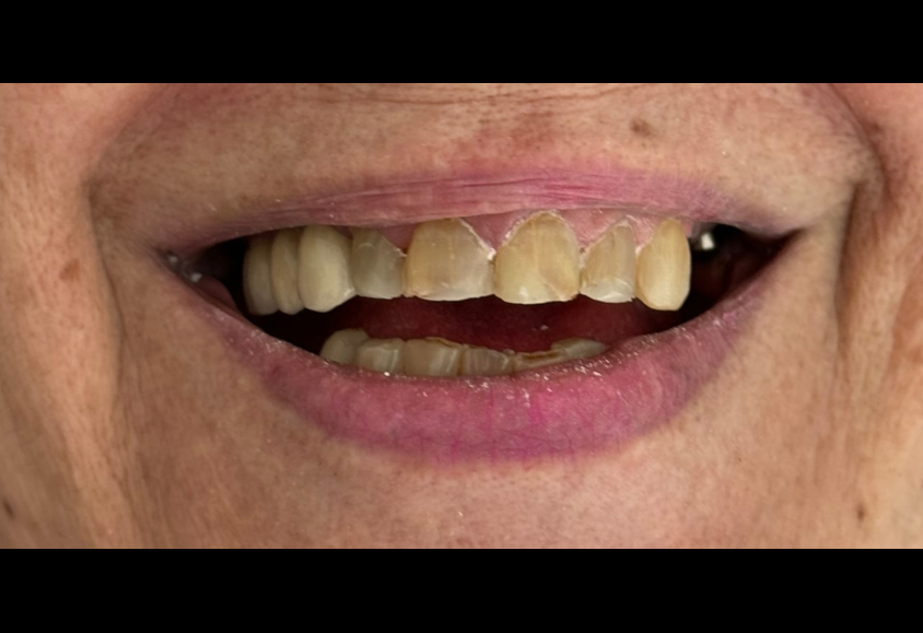 antes composite