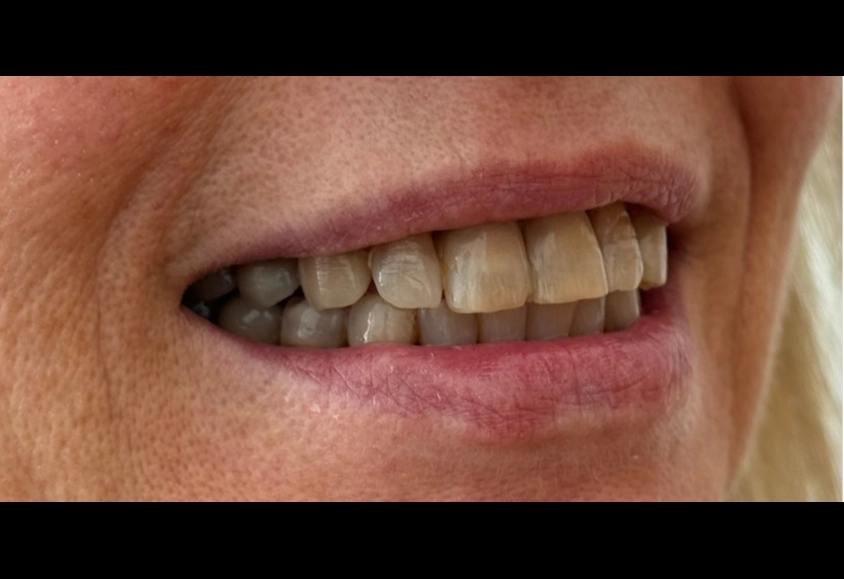 antes estetica dental 1