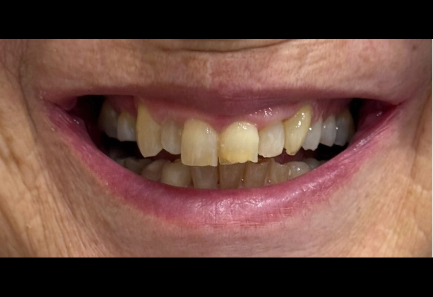 antes estetica dental 2