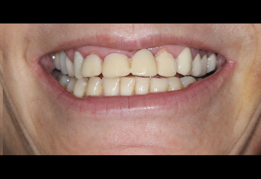 antes estetica dental 3