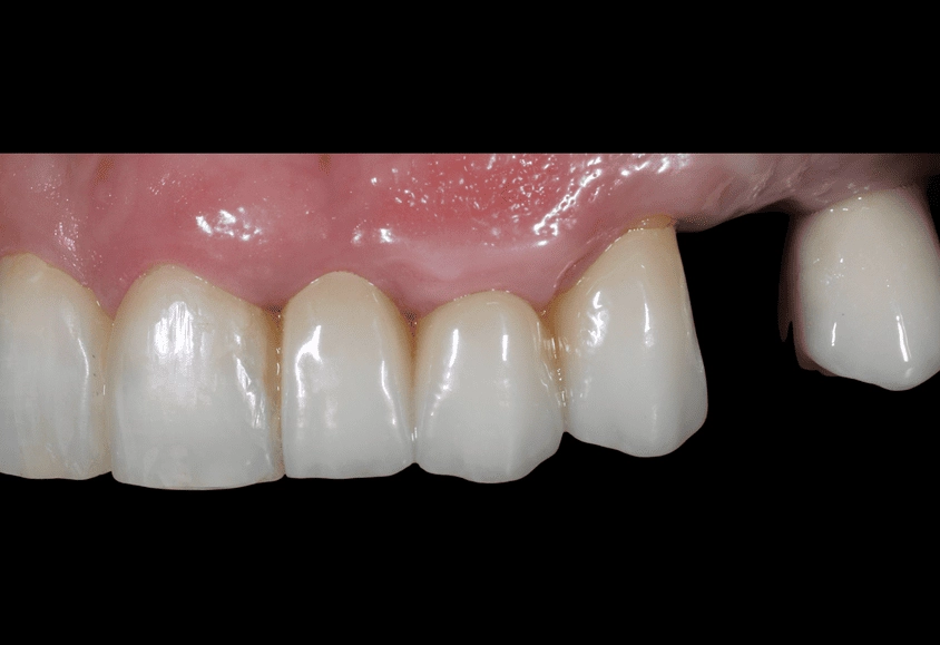 boca implante dental antes