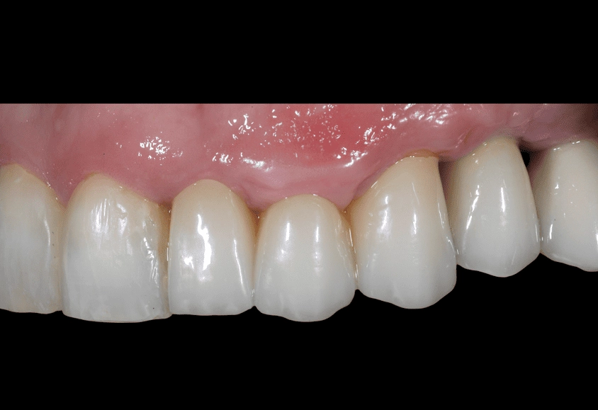 boca implante dental despues