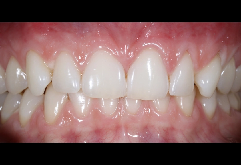 despues blanquemiento 3