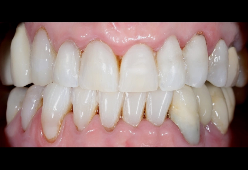 despues blanquemiento 4-1