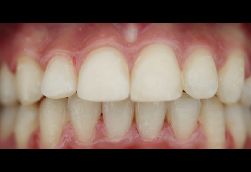 después del tratamiento con brackets 2