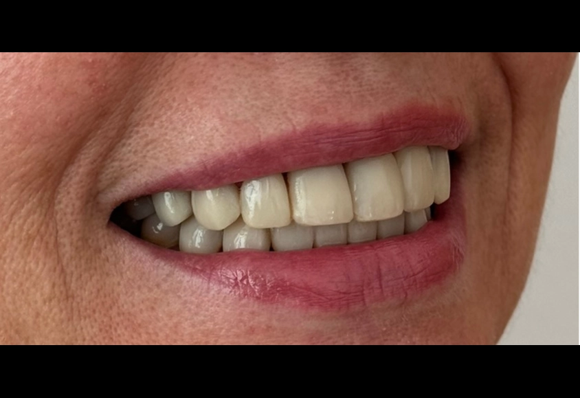 despues estetica dental 1