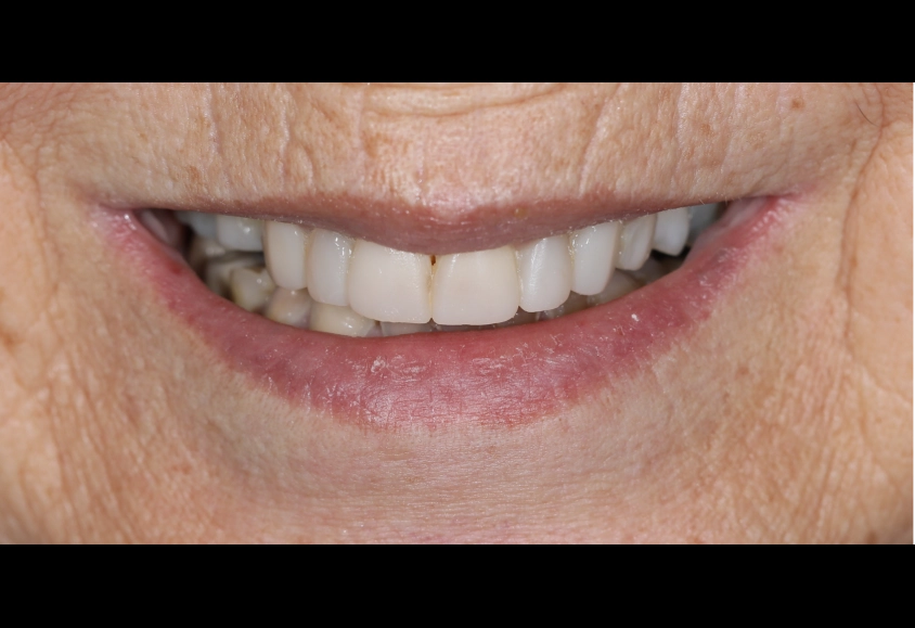 después estetica dental 2