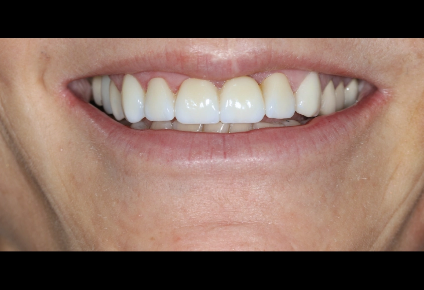 después estetica dental 3