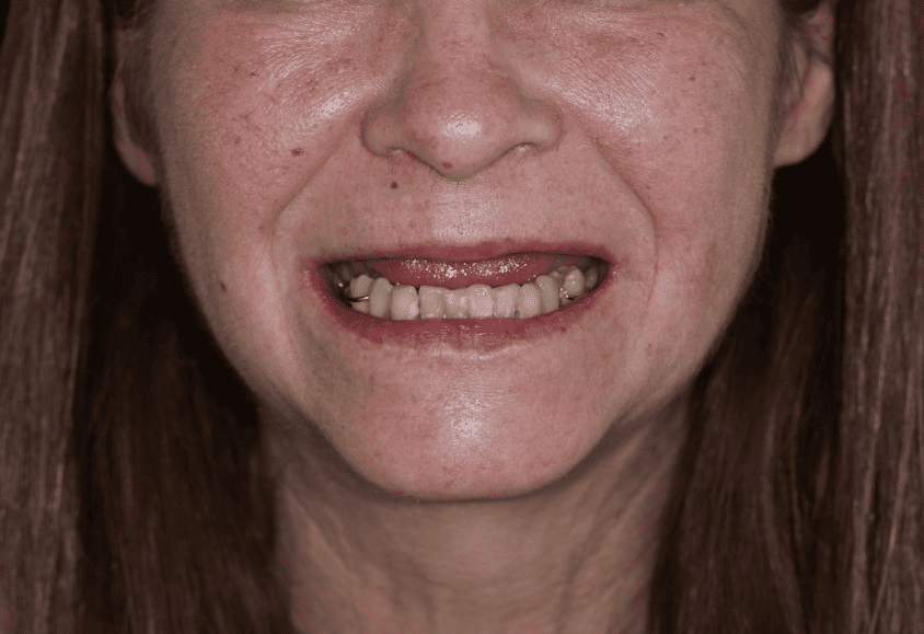 implantes dentales antes